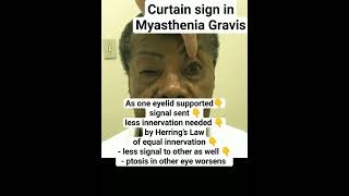 Curtain Sign Myasthenia Gravis mbbs [upl. by Madden]