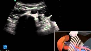 Guide 3D Ecografia Aorta Addominale  Ecografia SonoSite [upl. by Latrina996]