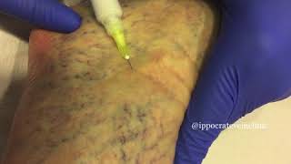 Sclerotherapy highlights [upl. by Avictor193]