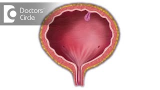 How is Bladder Cancer treated What is TURBT Dr Santosh Bethur [upl. by Liahcim722]