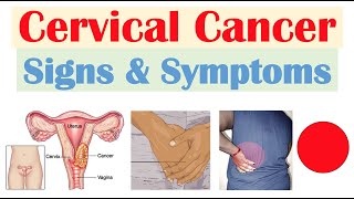 Cervical Cancer Signs amp Symptoms amp Why They Occur [upl. by Erait753]