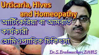 Urticaria  urticaria treatment  urticaria homeopathy  hives disease in bengali [upl. by Adav]