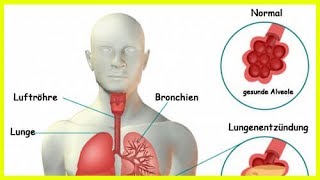 Lungenentzündung Symptome und unterstützende Naturheilmittel [upl. by Pris]