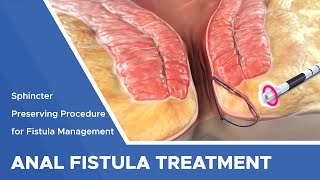 Closure of Fistula Tract with Laser [upl. by Wera317]