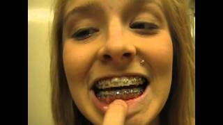 Braces Answering Your questions 4 Elastics [upl. by Hendrix]