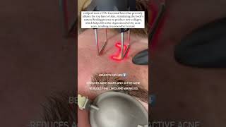 Acne Scars Skin Tightening Botox and Lip Fillers by Skinsation LA [upl. by Owiat]