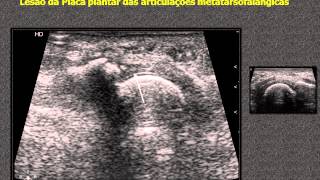 Foot ultrasound  metatarsophalangeal plantar plate injury [upl. by Fortune826]