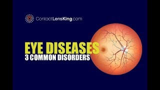 Eye Diseases  3 Common Eye Conditions [upl. by Bores]