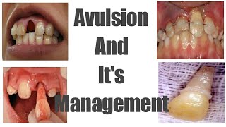 Avulsion  Avulsed tooth  Management  Treatment [upl. by Otilesoj]