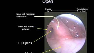 Eustachian Tube Dysfunction  ETD [upl. by Idnas]