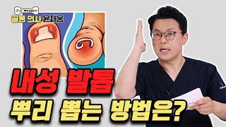 자꾸 재발하는 ‘내성 발톱’ 이렇게 치료하세요  골통 의사 윤재웅 69 내성발톱 [upl. by Enimrej]