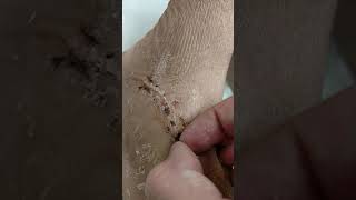 Picking scabs after cast removal 1 [upl. by Vogel16]