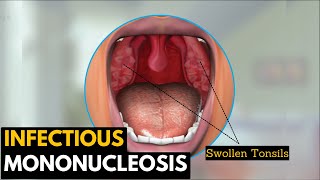 Infectious mononucleosis Causes Signs and Symptoms Diagnosis and Treatment [upl. by Sybyl905]