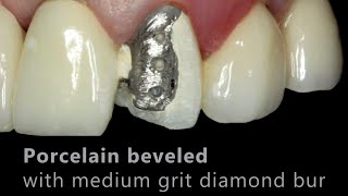 Porcelain Fused to Metal PFM Repair  Cosmedent Inc [upl. by Elburr378]