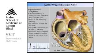 Supra Ventricular Tachycardia [upl. by Pascasia570]