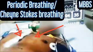 Periodic Breathing Cheyne Stokes Breathing mbbs medicine neetpg usmle next aiims neet [upl. by Ahseral663]