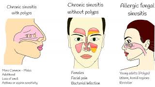 Chronic Sinusitis  Symptoms causes and treatment Sinusitis with polyps Fungal sinusitis [upl. by Puna]