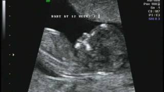 12 weeks 1 day Ultrasound [upl. by Asserac]