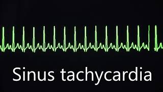 Sinus rhythm bradycardia and tachycardia [upl. by Meehahs]