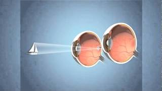 Monovision for Presbyopia [upl. by Adaj]