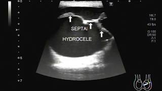 Ultrasound Video showing a large Epididymal cyst with hydrocelepyocele [upl. by Joeann]