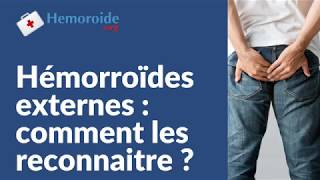 Hemorroides externes  comment les reconnaitre et les symptomes de lhemoroide externe [upl. by Eimot]