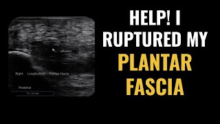 Ruptured Plantar Fascia Fasciitis  How to Diagnose and What are the Treatment Options [upl. by Assirroc261]