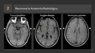 Cómo describir una RM de Cerebro [upl. by Maclaine]