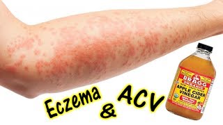 How To Treat Eczema with Apple Cider Vinegar [upl. by Michail]