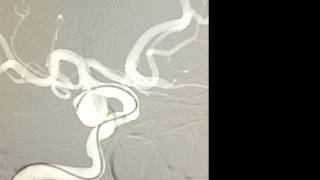 Endovascular coil embolization of unruptured posterior communicating artery aneurysm [upl. by Ibrahim790]