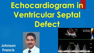 Comprehensive Approach to Atrioventricular Septal Defects [upl. by Aivlis789]