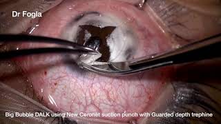 DALK Surgery Procedure using Coronet Trephine [upl. by Eerrehc]