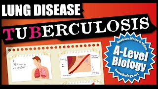 Lung Diseases  TB  Tuberculosis  A Level Biology Revision Notes [upl. by Wenoa]