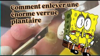 Comment enlever une énorme verrue plantaire [upl. by As]