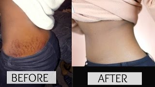 HOW TO GET RID OF STRETCH MARKS amp SCARS FAST [upl. by Gnurt656]