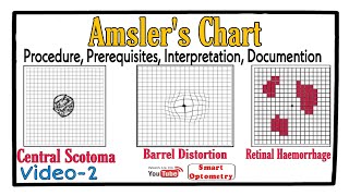 Amslers Chart Procedure Prerequisites Scotoma Interpretation Documention Video2 [upl. by Elynad787]