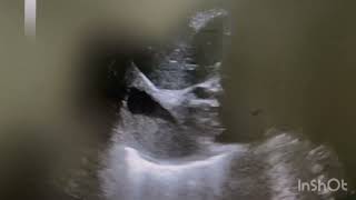 Ultrasound of Subdiaphragmatic abscess [upl. by Swehttam]