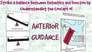 Anterior Guidance  Understanding the Concept [upl. by Anaira]