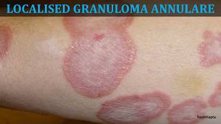 GRANULOMA ANNULARE [upl. by Artinad]