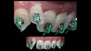 Orthodontic treatment of Class II division 2 Damon deep bite anterior bite turbo by Dr Amr Asker [upl. by Abdel564]