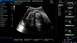 Ecografía Doppler Fetal [upl. by Terrej]