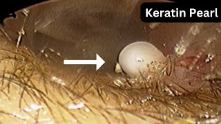 Keratin pearls in ear canal  bilateral symmetrical  without surgery [upl. by Murdocca]