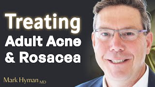 Treating Adult Acne amp Rosacea From The Inside Out [upl. by Lanctot537]