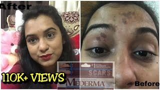 mederma cream review how to remove acne scar and stretch mark naturally live demo with mederma [upl. by Nobell]