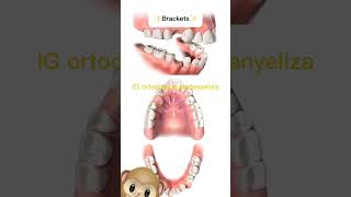 Extractions in orthodontics orthodontictips ортодонтия kieferorthopädie ortodonzia orthodontie [upl. by Yltsew402]