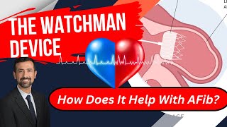 HOW WATCHMAN IMPLANTATION DEVICE WORKS [upl. by Erbua]