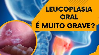 LEUCOPLASIA ORAL  MUITA ATENÇÃO PARA ESSA LESÃO NA BOCA  Dr Edinei Dias [upl. by Arimay]