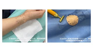 手首の粉瘤 ブログでも詳しく解説してます。 くりぬき法 東京皮膚のできものと粉瘤クリニック ふるばやし形成外科新宿院 大阪梅田形成外科クリニック [upl. by Maurreen563]