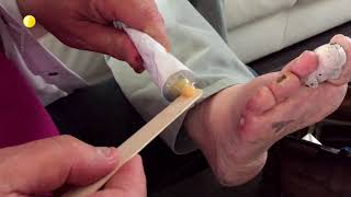 Medical Grade Honey on a chronic foot wound [upl. by Eiger]