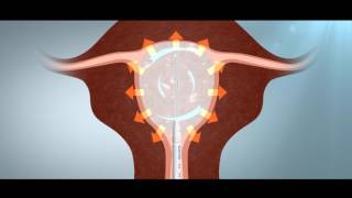 Cavaterm Procedure Instructions Video [upl. by Sinegra]